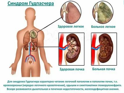 Синдром 3 почки