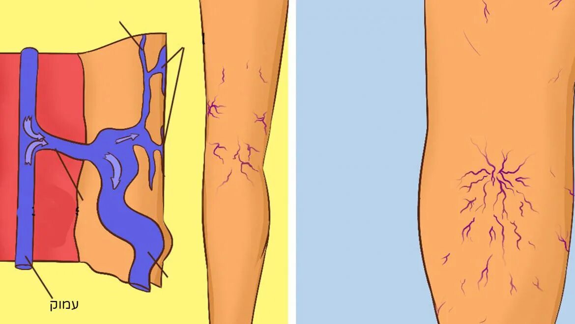 Ретикулярный варикоз ретикулярный. Варикозное расширение вен нижних конечностей (ВРВНК). Ретикулярная варикозная Вена. Варикозное расширение вен нижних конечностей рисунки. Что значат вены на ногах