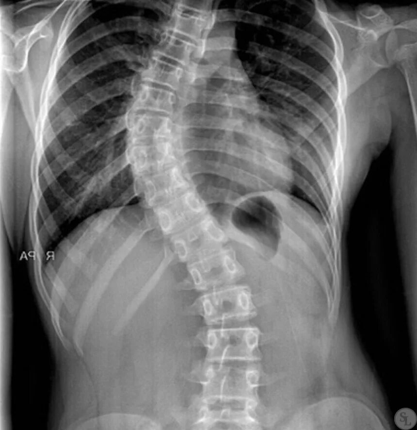 Сколиоз грудного отдела позвоночника степени рентген. Сколиоз 3 степени рентген. Сколиоз 2 степени снимок рентген. Сколиотическая деформация позвоночника рентген.