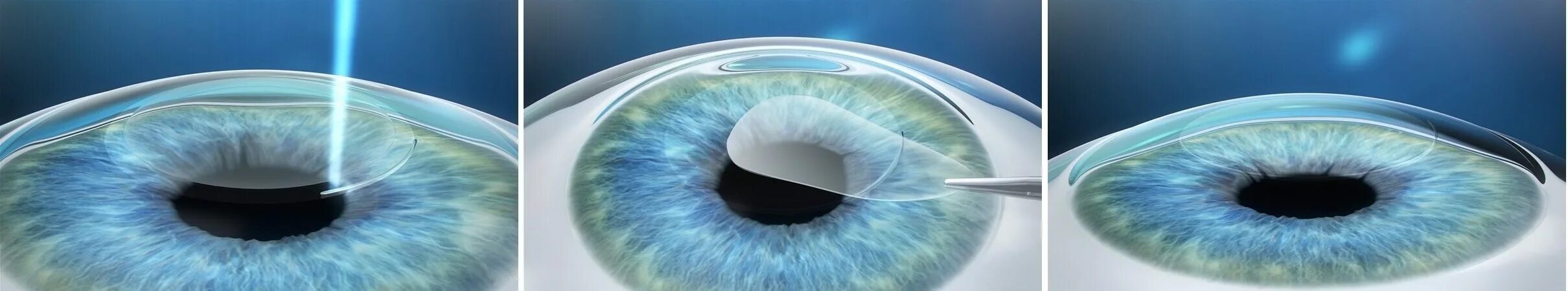 Лазерная коррекция зрения спустя много лет отзывы. Лазерная коррекция зрения Femto ласик. Рефракционная экстракция лентикулы. LASIK smile операция. Лазерная рефракционная кератопластика (методом Femto super LASIK).