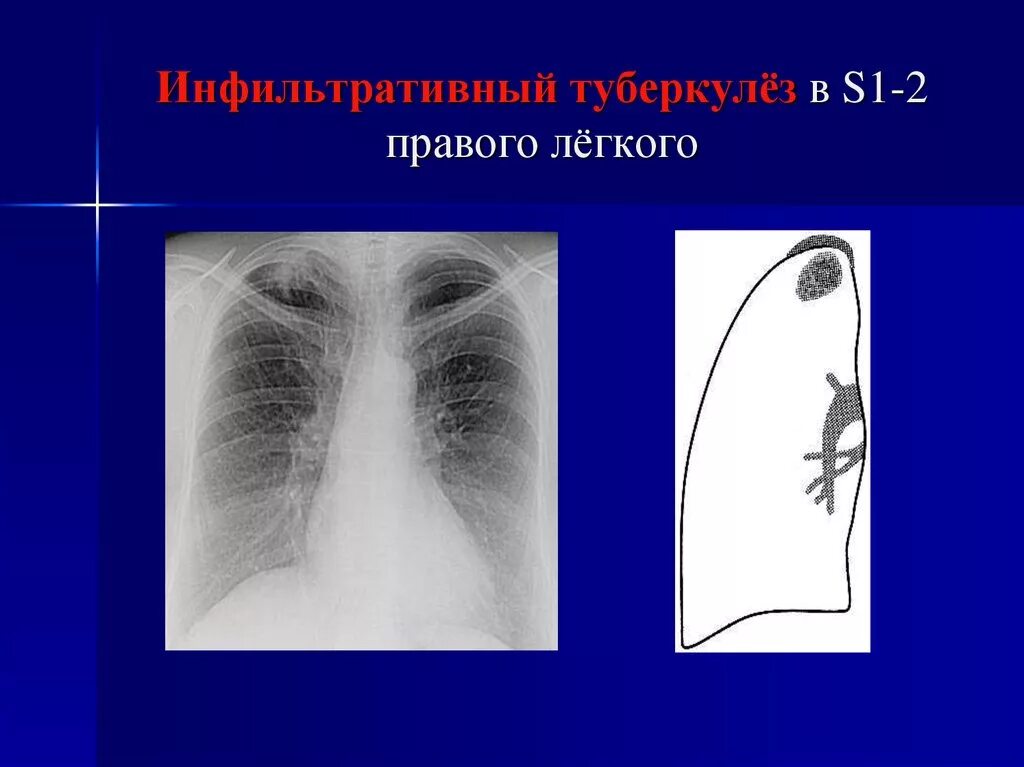 Туберкулез легких в фазе инфильтрации. Инфильтративный туберкулез рентгенография. Очаговый туберкулез верхней доли правого легкого в фазе инфильтрации. Инфильтративный туберкулез s1 s2. Инфильтративный туберкулез легких s1 s2.