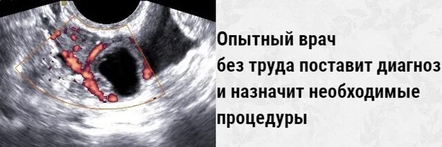 Можно ли увидеть внематочную беременность. Внематочная беременность узи признаки. внематочная беременность на узи. внематочная беременность по узи. внематочная беременность симптомы.