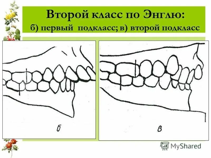 2 класс ортодонтии