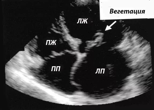 Вегетация сердца. Эхокардиография при инфекционном эндокардите. ЭХОКГ при инфекционном эндокардите. Инфекционный эндокардит эхокардиография. Вегетации на митральном клапане ЭХОКГ.