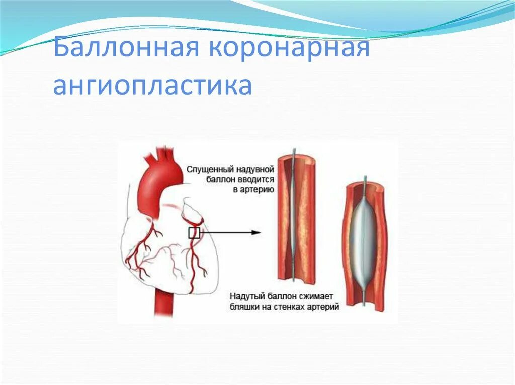 Баллонная коронарная ангиопластика. Коронарная ангиопластика. Баллонная ангиопластика и стентирование. Субинтимальная баллонная ангиопластика.