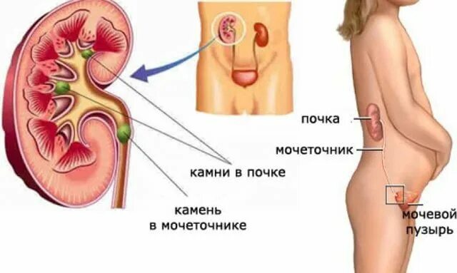 Боли после выхода камня
