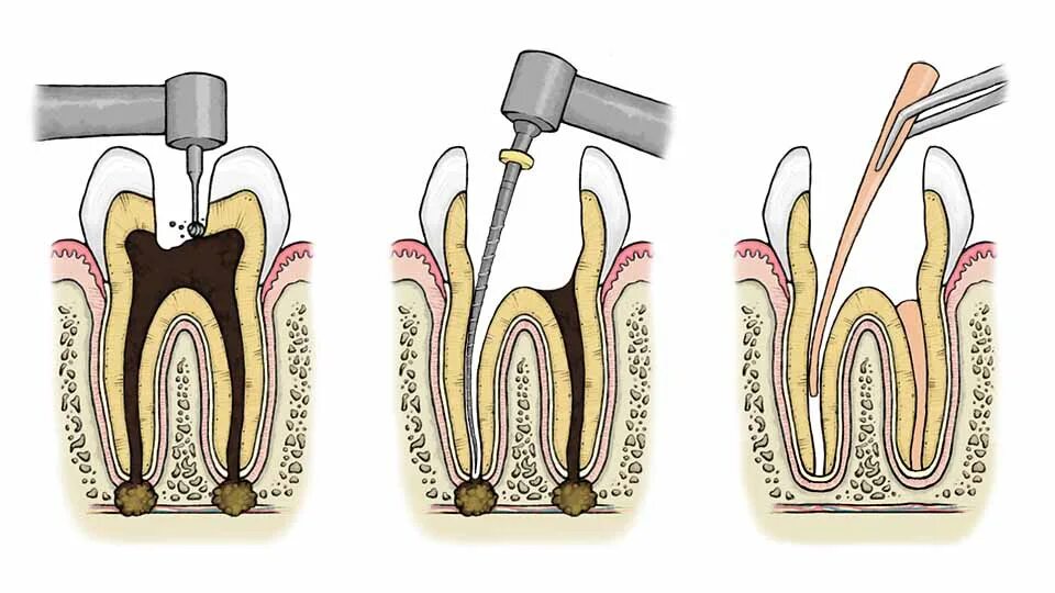 Распломбировка каналов зуба. Перепломбировка каналов зуба. Запломбированные корневые каналы зуба. Пломбирование 1 корневого канала. Корневые каналы обтурированы.