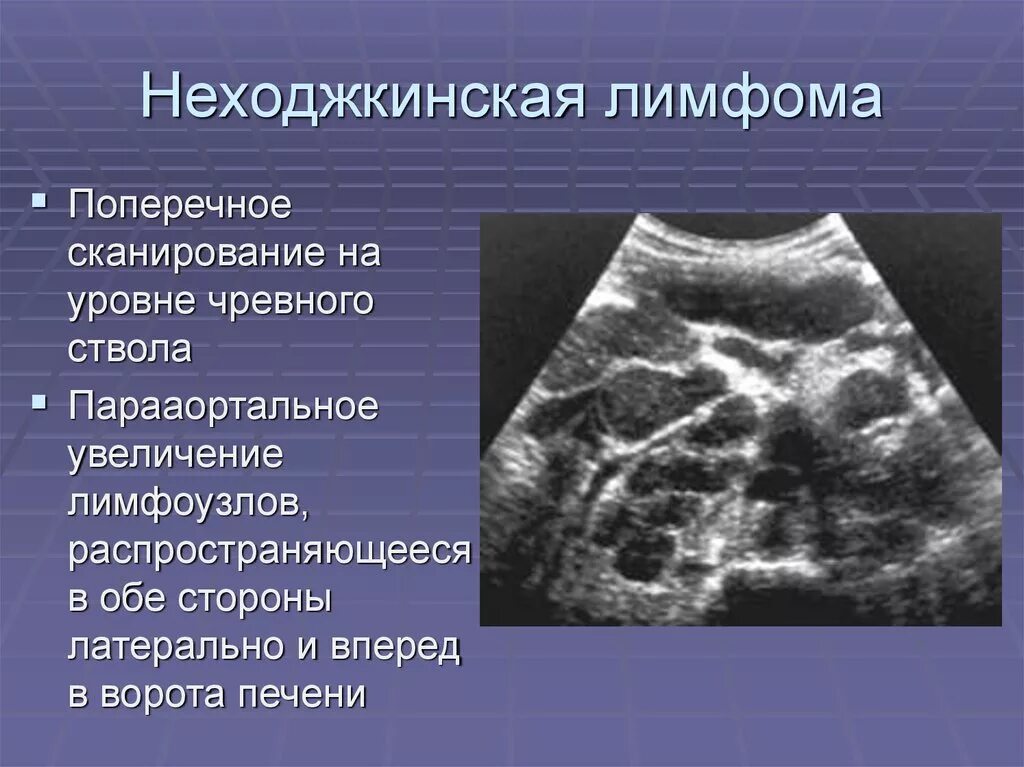 Лимфома неходжкинская УЗИ лимфоузлов. УЗИ парааортальных лимфатических узлов. Неходжкинская лимфома УЗИ селезенки.