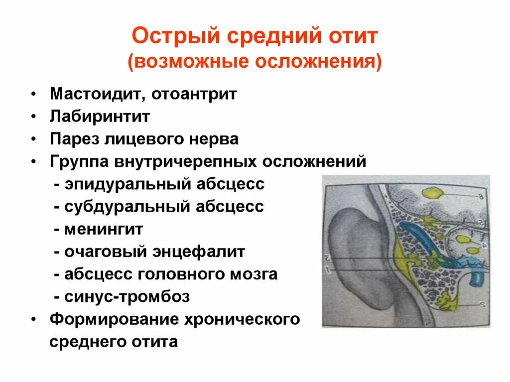 Острый средний отит осложнения. Осложнения заболеваний среднего уха. Осложнения острого среднего уха. Осложнения острого среднего отита. Причины воспаления среднего уха