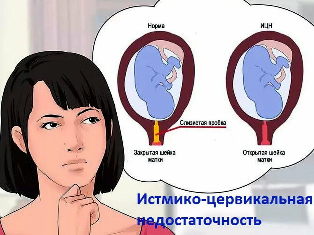Ицн шейки