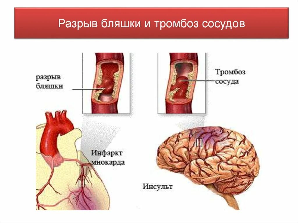 Разрыв бляшки. Инсульт и инфаркт. Инфаркт от инсульта. Инфаркт и инсульт разница.