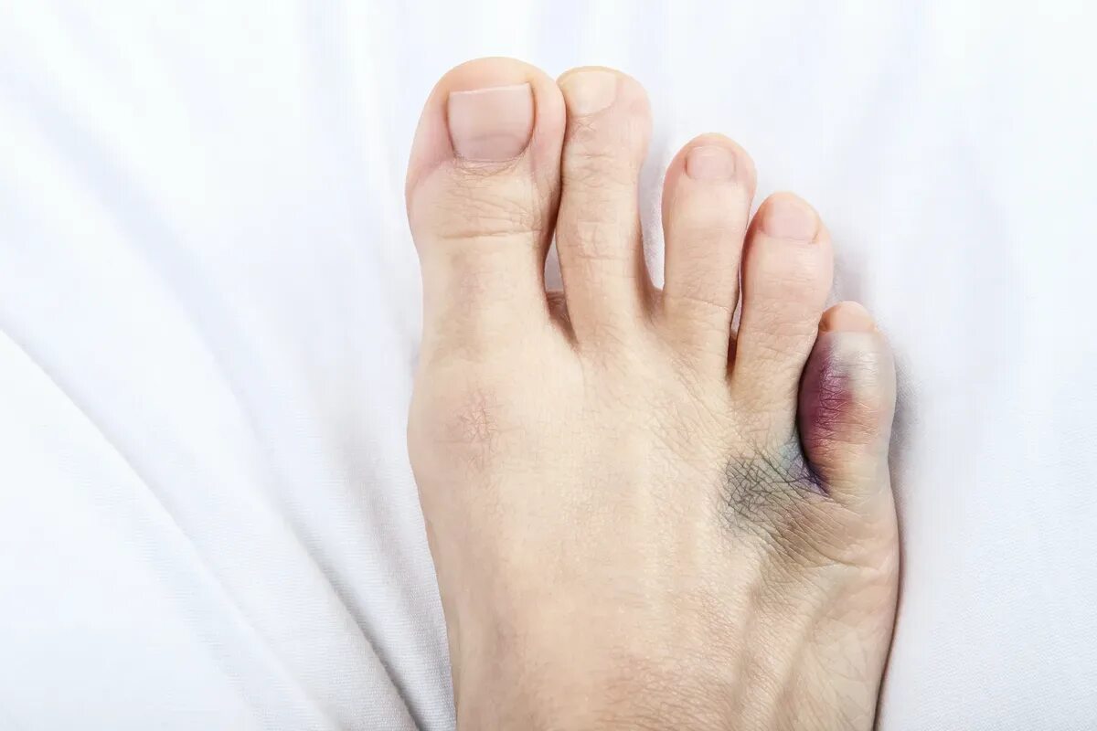 Bunion hallux valgus. Ногти на ногах. Большой палец на ноге без нокты. Стопа без большого пальца. Операция халлюкс вальгус.