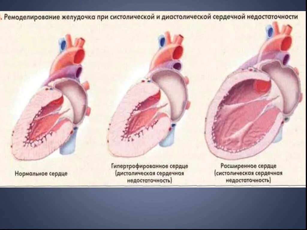 Недостаточность предсердия. ХСН гипертрофия левого желудочка. Недостаточностьлевого желудоч4а. Миокарда при сердечной недостаточности. Типы ремоделирования сердца.