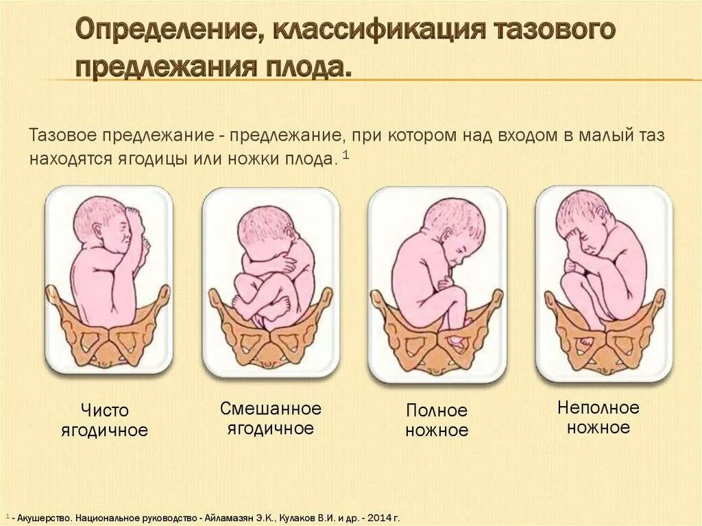 Тазовое предлежание плода кесарево. Тазовое предлежание продольное положение. Продольное положение ягодичное предлежание. Положение плода продольное предлежание тазовое. Положение плода продольное тазовое 1 позиция.