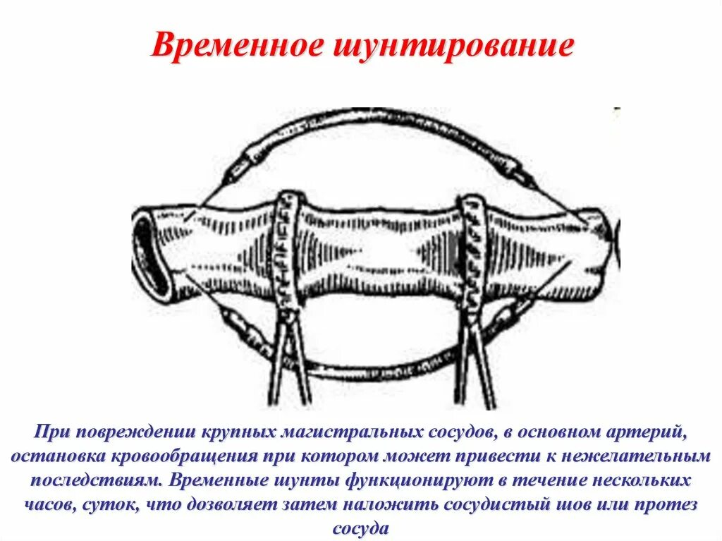 Шунтирующие сосуды. Временное шунтирование сосуда. Временное шунтирование сосуда при кровотечении. Временное шунтирование крупных сосудов. Временное шунтирование магистрального сосуда.