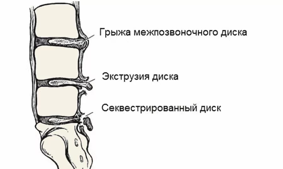 Экструзия диска l5-s1 что это такое. Дорзальная секвестрированная грыжа l5/s1. Экструзия дисков позвоночника l5-s1. Грыжа диска позвоночника l5 s1. Экструзия дисков шейного отдела позвоночника