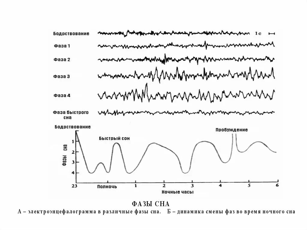 Фазы сна на ээг. Фаза быстрого сна ээг. Стадии сна параметры ээг. Фаза быстрого сна ээг. Фаза быстрого сна ээг.