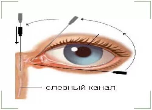 Как пробивают слезный канал. Непроходимость слезного канала зондирование. Зондирование глаза слезного канала. В 10 месяцев зондирование слезного канала у новорожденных. Дакриоцистит промывание слезных путей.