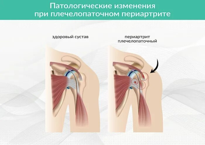 Плечевой периартрит что это. Периартрит плечевого сустава. Плечелопаточный периартрит симптомы. Спинно лопаточный периартрит. Периартроз плечевого сустава патогенез.