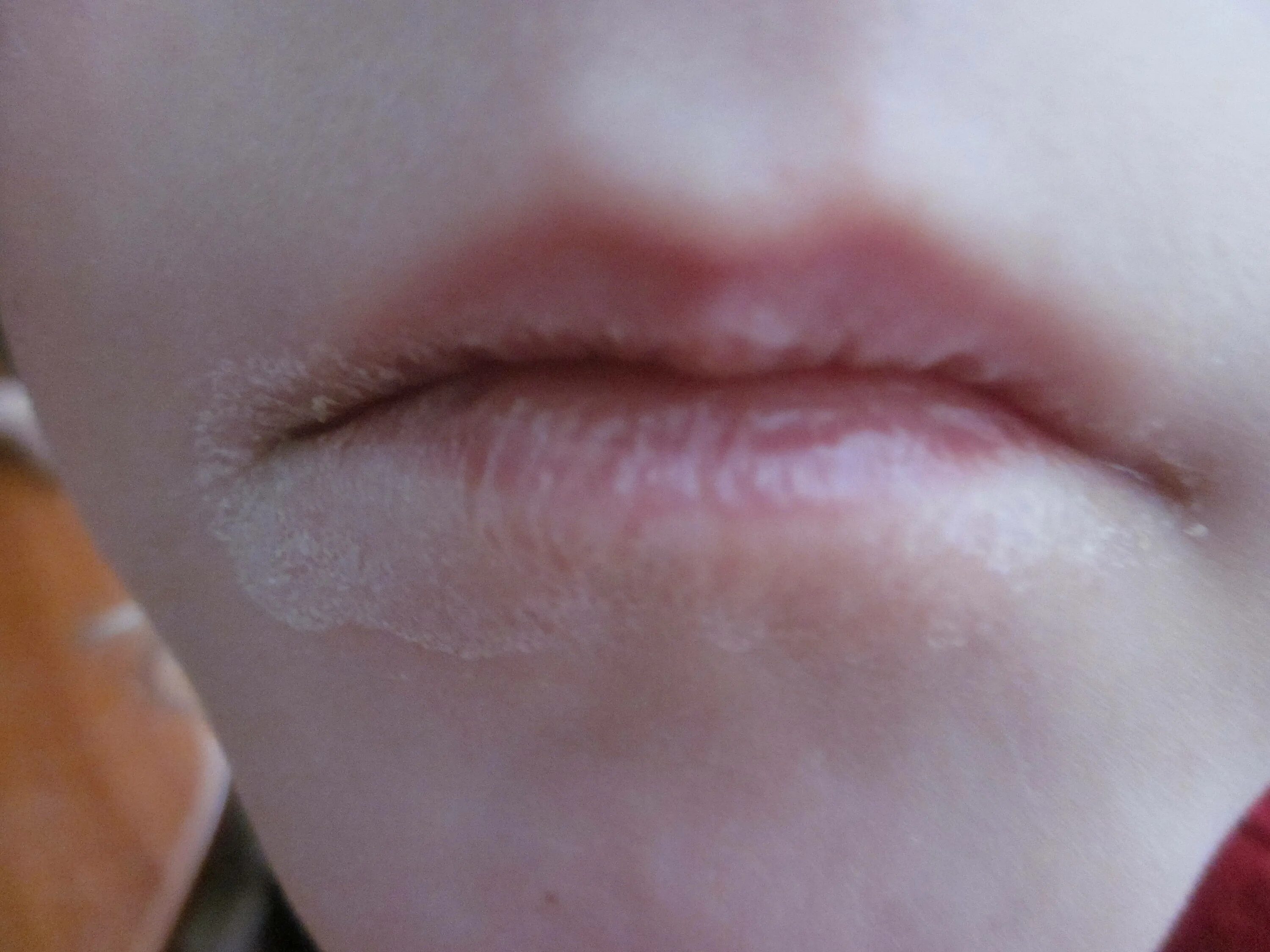 Почему белеют губы у женщин. Эксфолилиативный хейлит. Бледные губы. Почему белеют губы у женщин. Почему белеют губы у женщин.