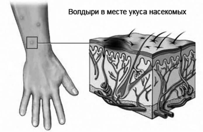 Почему чешется комариный. Волдырь после укуса насекомого. волдырь после комариного укуса. почему чешется укус комара.