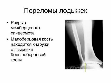 Перелом проксимального отдела большеберцовой кости