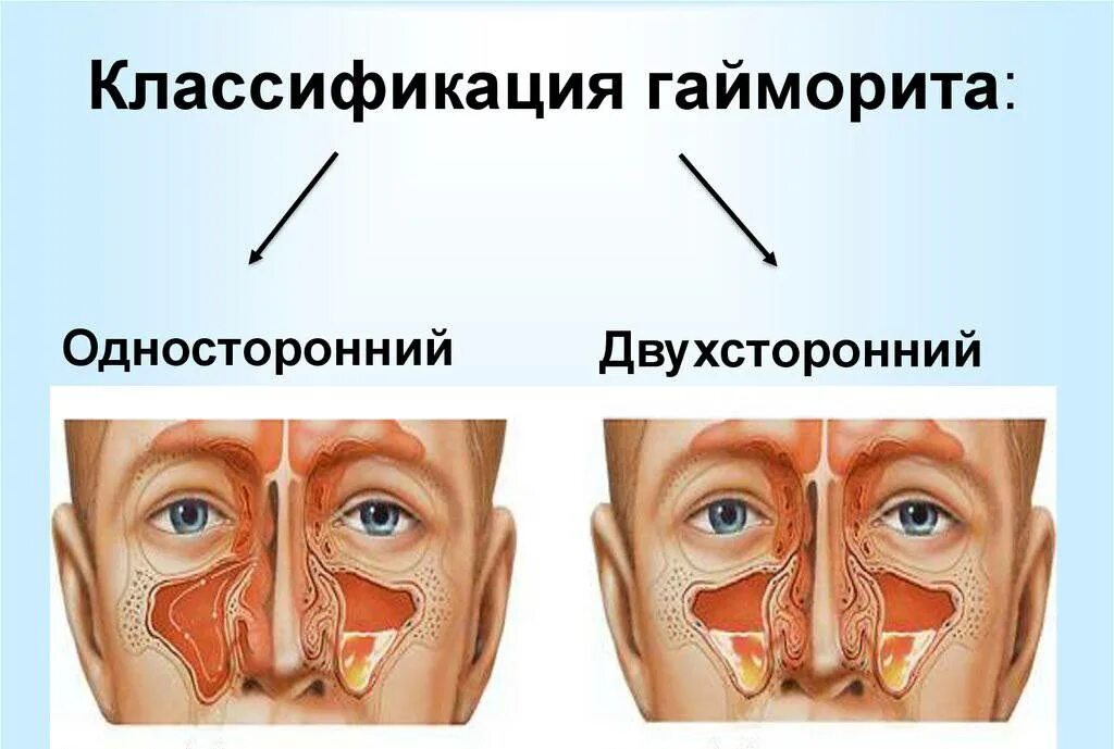 Гайморит что это