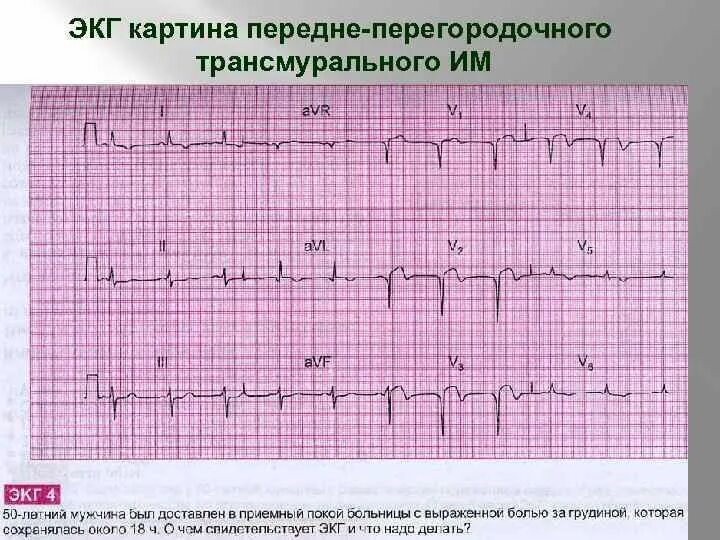 Нарушение реполяризации передне перегородочной области. Инфаркт миокарда передней стенки ЭКГ. Острый трансмуральный инфаркт нижней стенки миокарда ЭКГ. Передневерхушечный инфаркт миокарда на ЭКГ. Трансмуральный инфаркт на ЭКГ признаки.