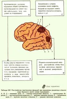 Соматоагнозия