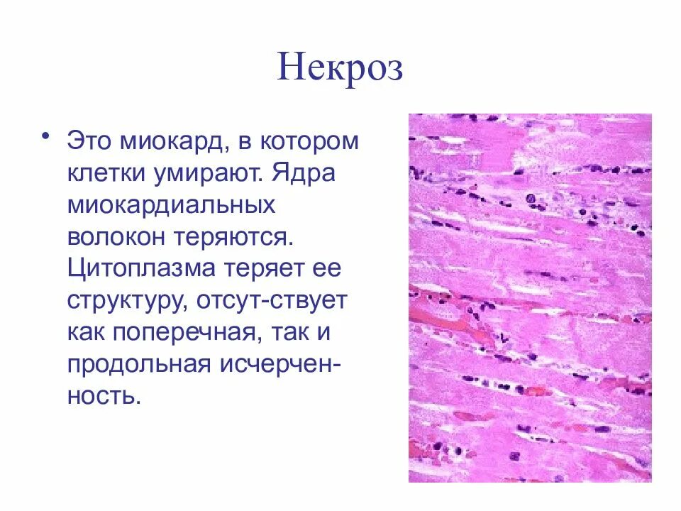 Кариопикноз это. Первичный некроз тканей. Некроз отмирание тканей.