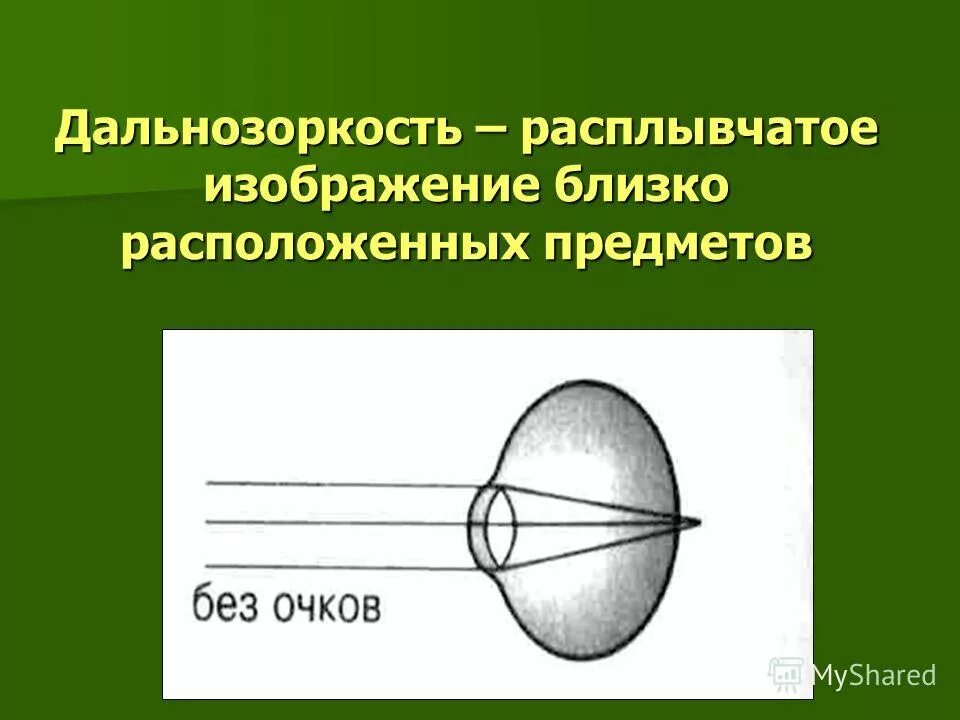 Нарушение зрения презентация. Дальнозоркость биология. Расплывчатое изображение близко расположенных предметов. Строение глаза дальнозоркость. Расплывчатое изображение близко расположенных предметов.
