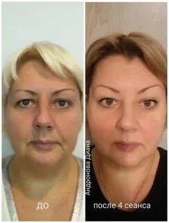 Витапластика лица что это такое отзывы