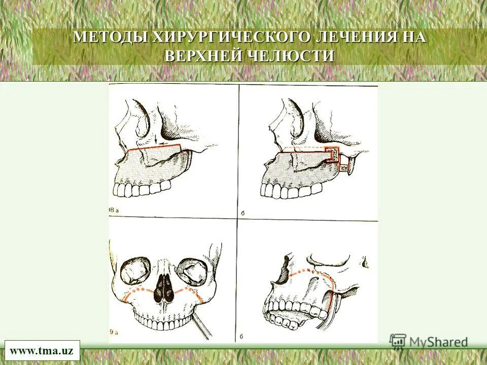 дистальная окклюзия ортогнатическая хирургия. сегментарная остеотомия челюсти. компрессионно-дистракционный остеосинтез нижней челюсти. дистальный прикус операция. решетчатая компактостеотомия нижней челюсти.
