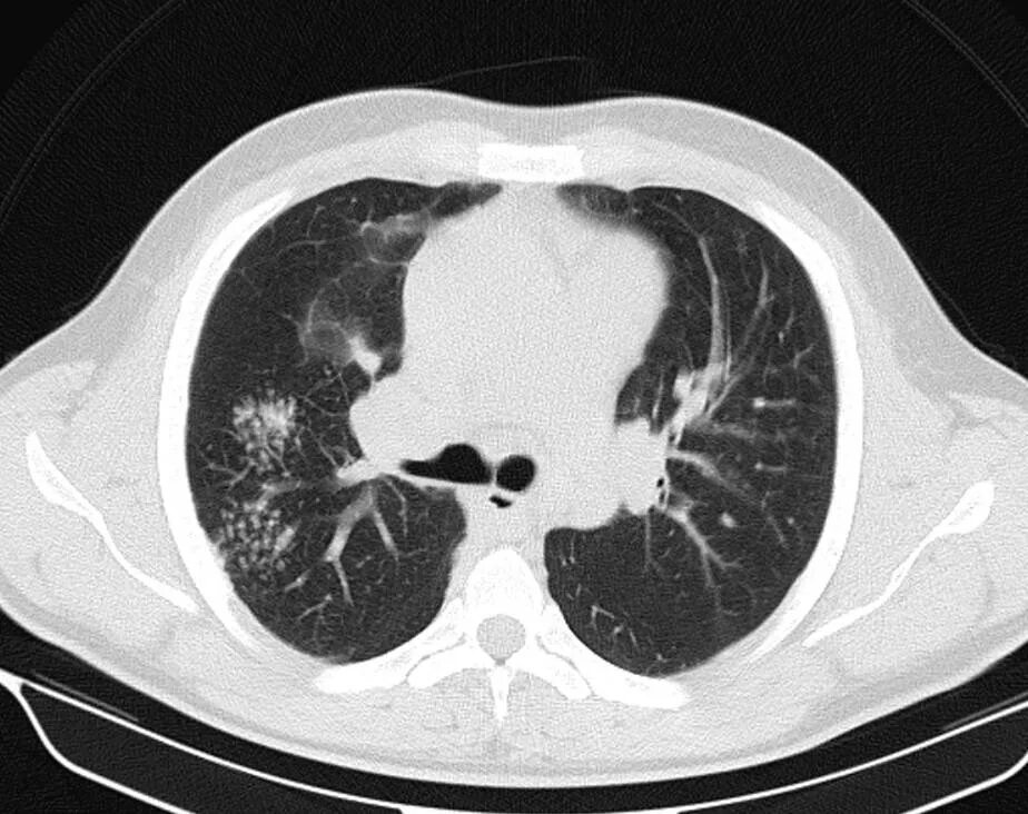 Эозинофильная пневмония кт. Томограмма грудной клетки. Рентгеновская томограмма грудной клетки. Кт патологии ОГК. Кт органов брюшной полости грудной клетки