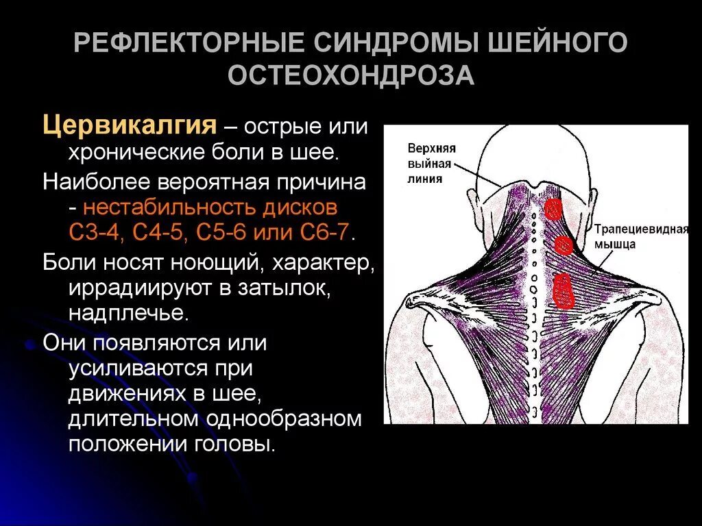 Цервикалгия шейного отдела позвоночника что это такое. Синдром цервикалгии шейный отдел. Вертебная цервикалдия. Шейные позвонки и мышцы.