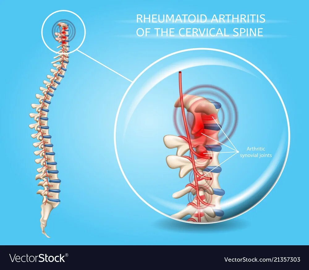артрит суставов позвоночника. цервикальные позвоночника. ревматоидный артрит суставы. остеопороз остеоартроз остеохондроз. анкилозирующего спондилоартрита бехтерева.