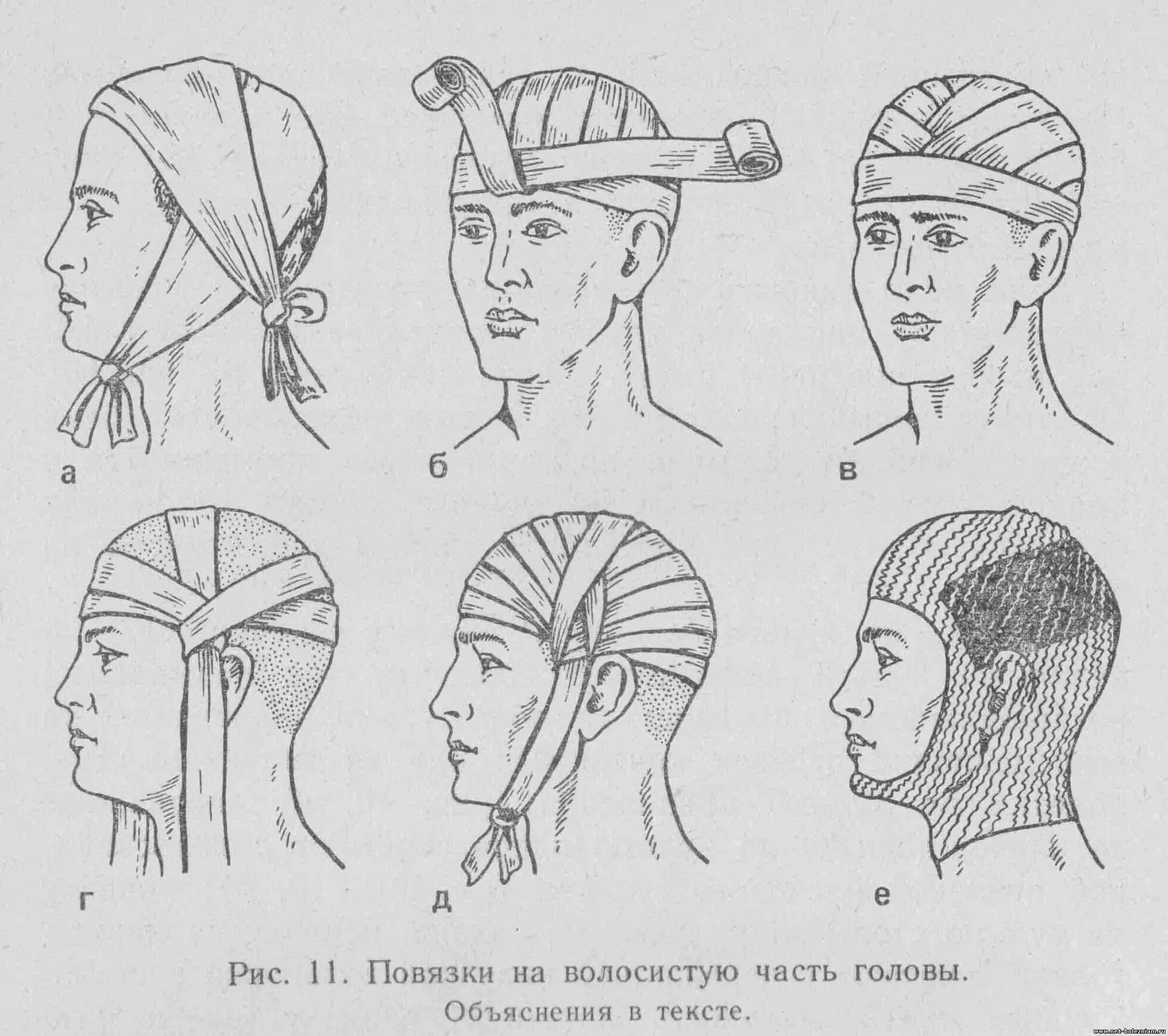 Как перевязывать голову. Перевязка головы чепец. Десмургия повязка чепец. Повязка чепец Гиппократа. Перевязка головы бинтом чепец.