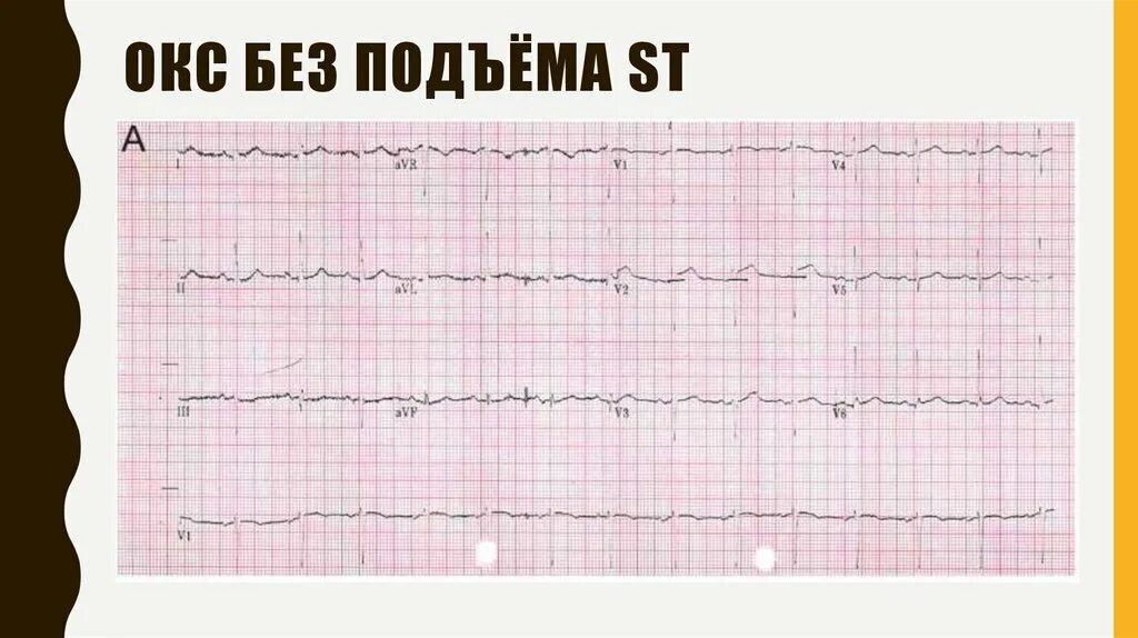 Окс без подъема St. Окс без подъема ст на ЭКГ. Окс с подъёмом St ЭКГ. ЭКГ инфаркт миокарда без подъема St. Без подъема st на экг