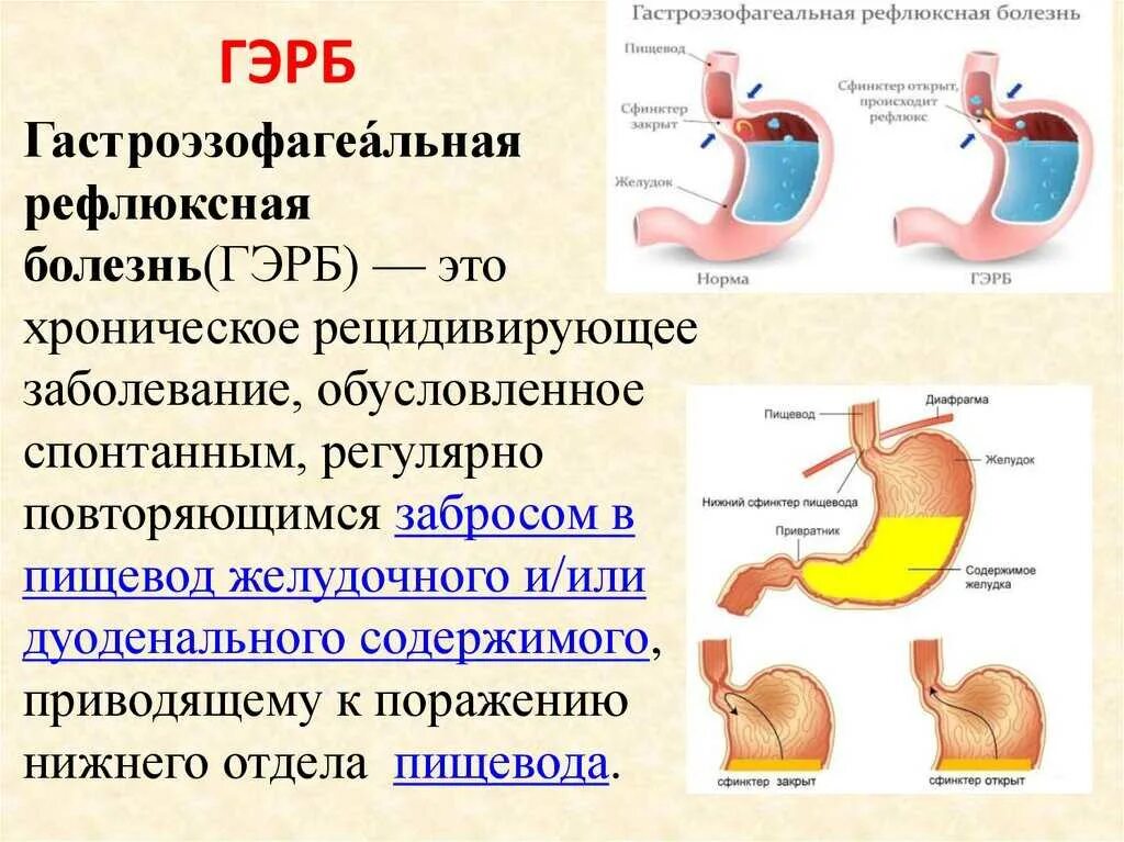 Почему изжога после еды причины. Гастроэзофагеальная рефлюкс-болезнь. Гастроэзофагеальная рефлюксная Гастроэзофагеальная болезнь. Гастроэзофагеальной рефлюксной болезни. Газоэзофагальнаярефлюксная болезнь.