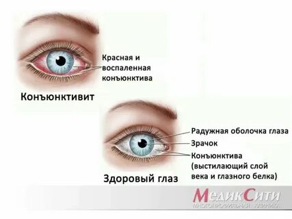 Коньюктивит глаза лечение