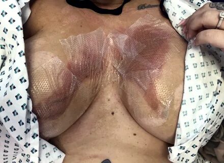 Glamour model's 36E fake boobs MELTED when she spilt boiling hot water from ...