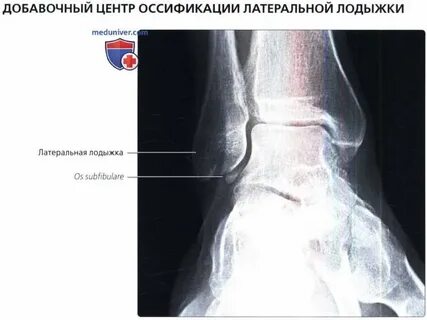 Отек медиальной лодыжки