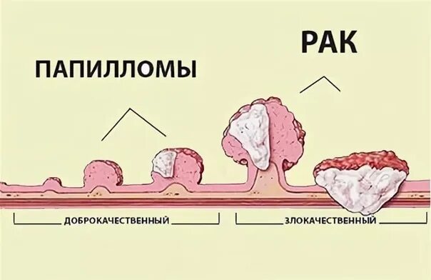 Остроконечные бородавки (кондиломы). Генитальные бородавки (ВПЧ). Рак головки члена