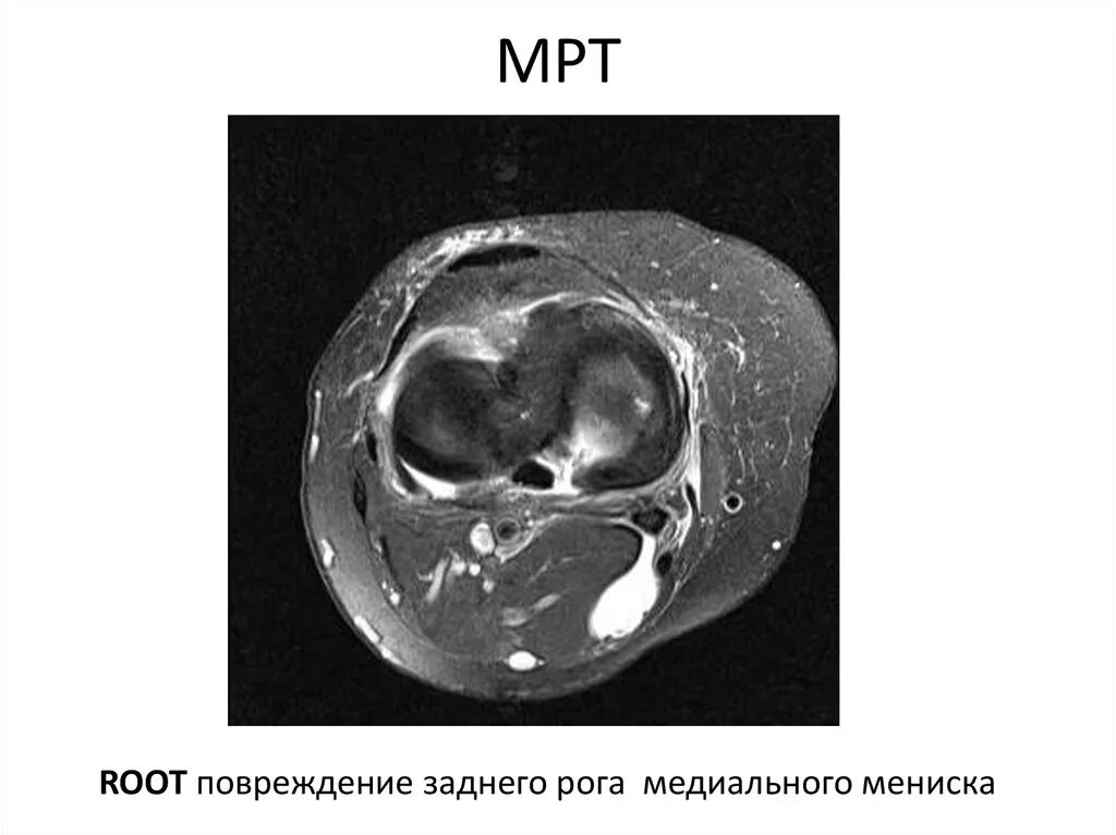 Мрт разрыв заднего рога мениска. Разрыв заднего рога медиального мениска коленного сустава мрт. Повреждение заднего рога медиального мениска Stoller 2. Разрыв заднего рога медиального мениска на мрт.