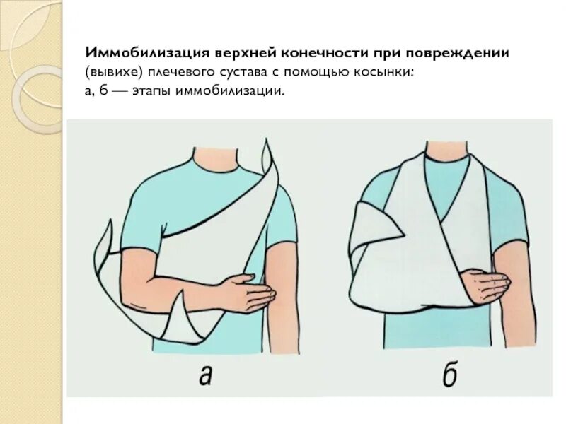 Первая помощь при вывихе плеча. Иммобилизация конечности при вывихе. иммобилизация верхней конечности. косынка на руку при вывихе. иммобилизация при вывихе плеча.