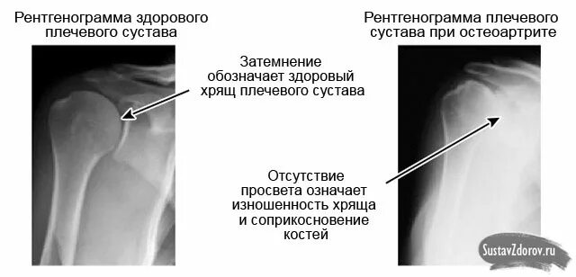 Сильные боли в плечевом суставе левой руки. Артроз плечевого сустава 1 степени рентген. Артроз плечевого сустава стадии рентген. Стадии остеоартроза плечевого сустава. Артроз плечевого сустава на рентгенограмме.