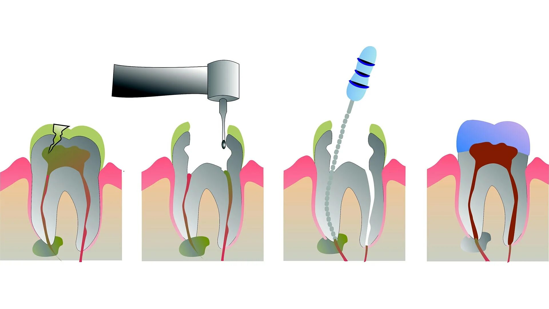 Root canal. Эндодонтия схема. Депульпирование зуба (удаление нерва).