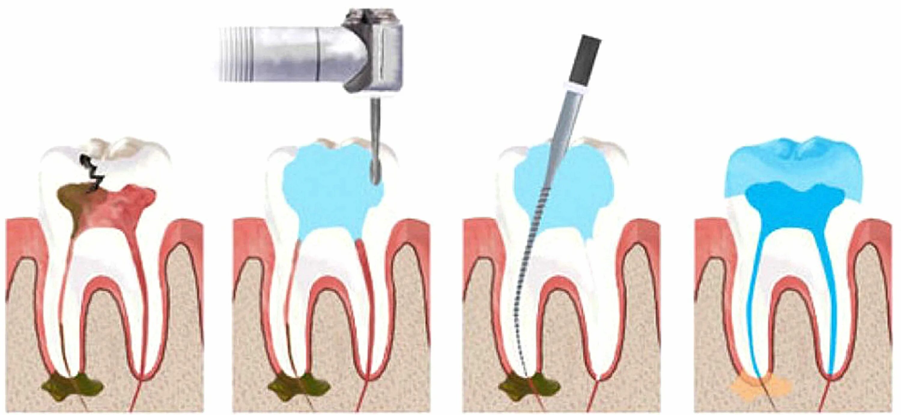 Root canal. Распломбировка корневых каналов. Острый очаговый пульпит. Пульпит пломбировка каналов.