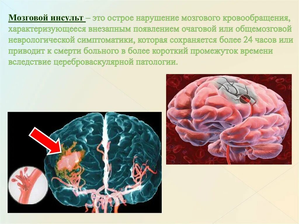 Мозговое кровообращение неврология. Ишемический инсульт поражения артерий. Нарушение мозгового кровообращения инсульт. Инсульт острое нарушение мозгового кровообращения.