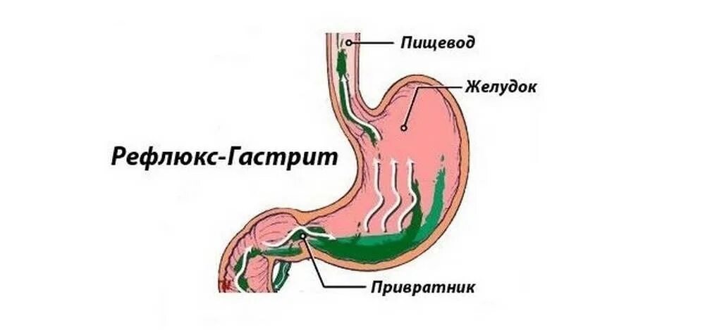 Заброс кислоты в пищевод